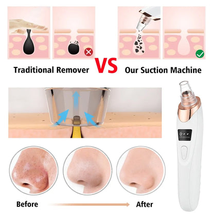 Blackhead Remover Vacuum